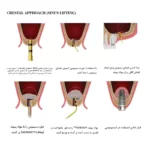 کیت پیشرفته سینوس لیفت اوپن و کلوز کاریزما – 15 عددی – Open & Close Sinus Lift