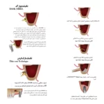 کیت پیشرفته سینوس لیفت اوپن و کلوز کاریزما – 15 عددی – Open & Close Sinus Lift