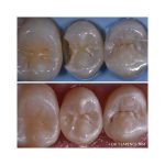 کامپوزیت نانو پلاس کازمادنت Cosmedent Renamel