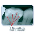 کامپوزیت فلو دیمارک کازمادنت Cosmedent De-Mark