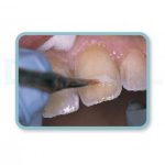 قلم موی کامپوزیت کازمادنت Cosmedent Brushes