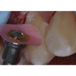 کیت دیسک پرداخت کامپوزیت ۶۰۰ عددی کازمادنت Cosmedent FlexiDisk