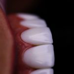 کامپوزیت سرامیکی هی تک مدل هی دنت Heydent