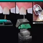 قالب پیش ساخته کامپوزیت UVeneer برند Ultradent - کیت قالب آماده ونیر کامپوزیت UltraDent - Uveneer - قالب پیش ساخته کامپوزیت اولترادنت, قیمت قالب پیش ساخته کامپوزیت, خرید قالب پیش ساخته کامپوزیت,فروش قالب پیش ساخته کامپوزیت, خرید اینترنتی قالب پیش ساخته کامپوزیت اولترادنت, , U Veneer,Ultradent فروش اینترنتی قالب پیش ساخته کامپوزیت, قالب پیش ساخته کامپوزیت ارزان, ارزان ترین قالب پیش ساخته کامپوزیت, قالب پیش ساخته کامپوزیت اصل, بهترین قالب پیش ساخته کامپوزیت