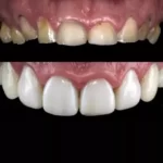 قالب پیش ساخته کامپوزیت بزرگ U Veneer Extra برند Ultradent - کیت قالب آماده ونیر کامپوزیت UltraDent - Uveneer Extra - کیت قالب آماده ونیر کامپوزیت - قالب پیش ساخته کامپوزیت بزرگ