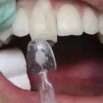 قالب پیش ساخته کامپوزیت بزرگ U Veneer Extra برند Ultradent - کیت قالب آماده ونیر کامپوزیت UltraDent - Uveneer Extra - کیت قالب آماده ونیر کامپوزیت - قالب پیش ساخته کامپوزیت بزرگ