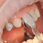 قالب پیش ساخته کامپوزیت بزرگ U Veneer Extra برند Ultradent - کیت قالب آماده ونیر کامپوزیت UltraDent - Uveneer Extra - کیت قالب آماده ونیر کامپوزیت - قالب پیش ساخته کامپوزیت بزرگ